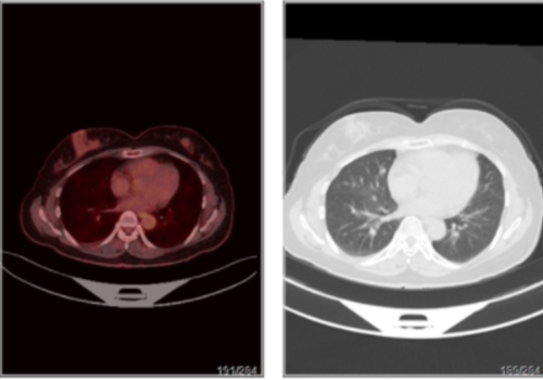 右腹阵发性疼痛数年做PETCT检查详查案例-全国PETCT/MR检查预约网_癌症筛查_肿瘤复查_高端体检