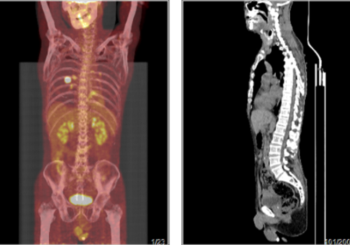 右肺占位，做PETCT检查详查案例-全国PETCT/MR检查预约网_癌症筛查_肿瘤复查_高端体检