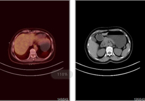 肿瘤标志物升高，做PETCT检查详查案例-全国PETCT/MR检查预约网_癌症筛查_肿瘤复查_高端体检
