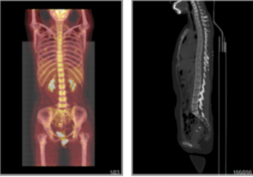 体检CA199升高，做PETCT检查详查案例-全国PETCT/MR检查预约网_癌症筛查_肿瘤复查_高端体检
